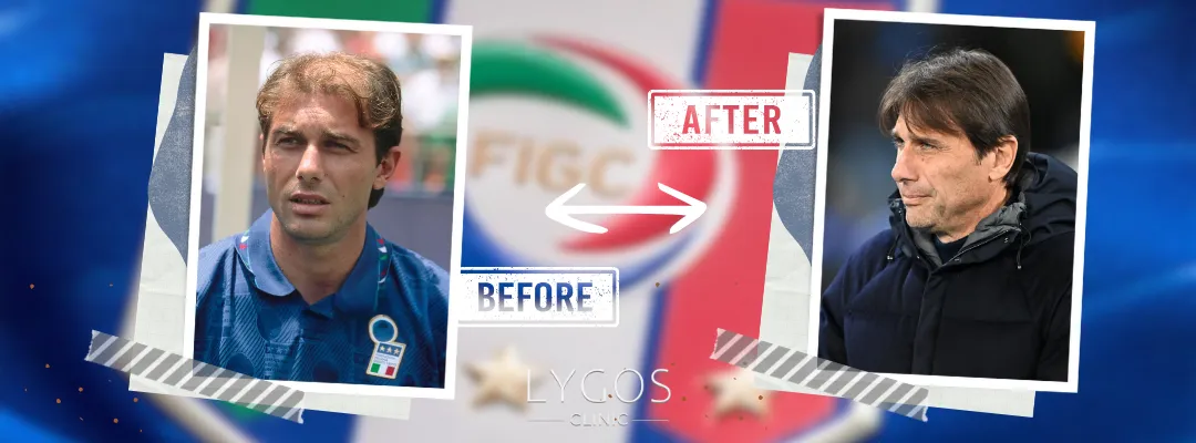 Antonio Conte Before and After Hair Transplant