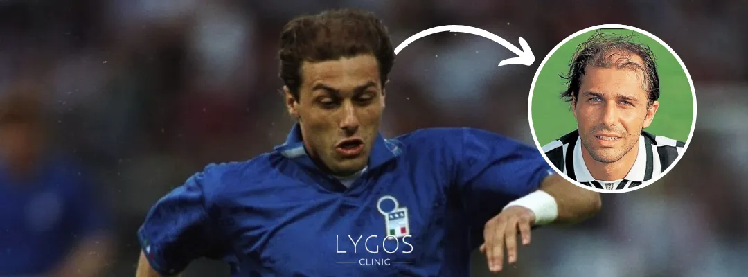 Antonio Conte Hair Loss