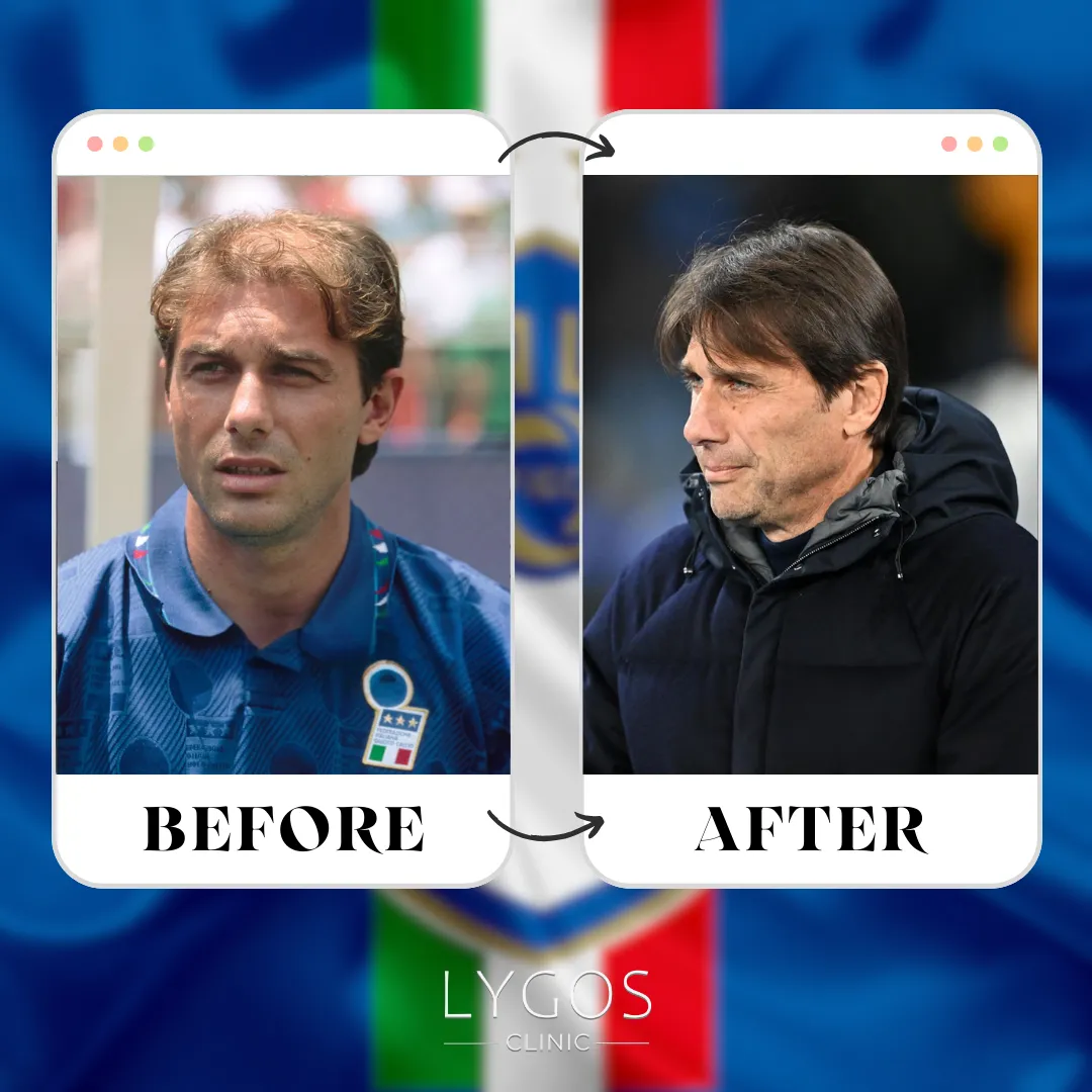 Antonio Conte Hair Transplant | Before and After 1 Antonio Conte Hair Transplant