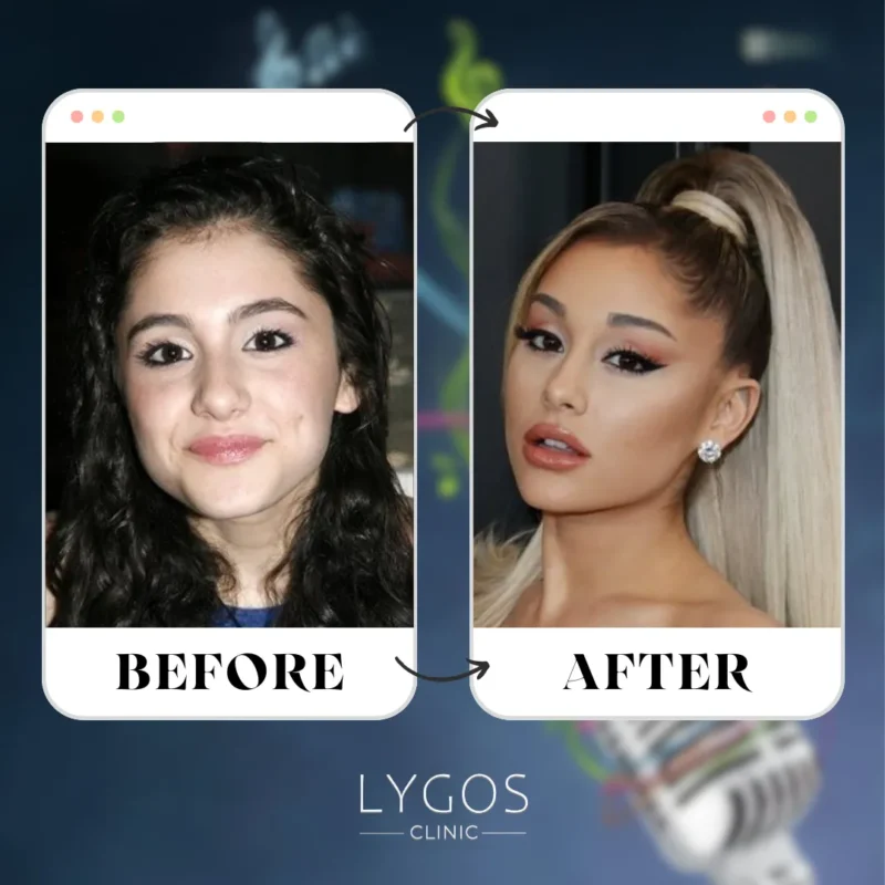 Ariana Grande Rhinoplasty