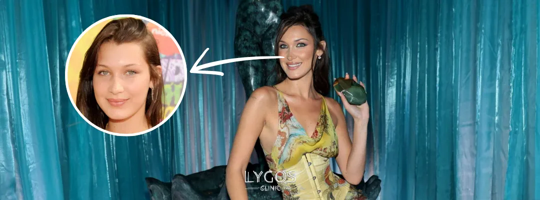 Bella Hadid Burun Estetiği Yaptırdı mı?