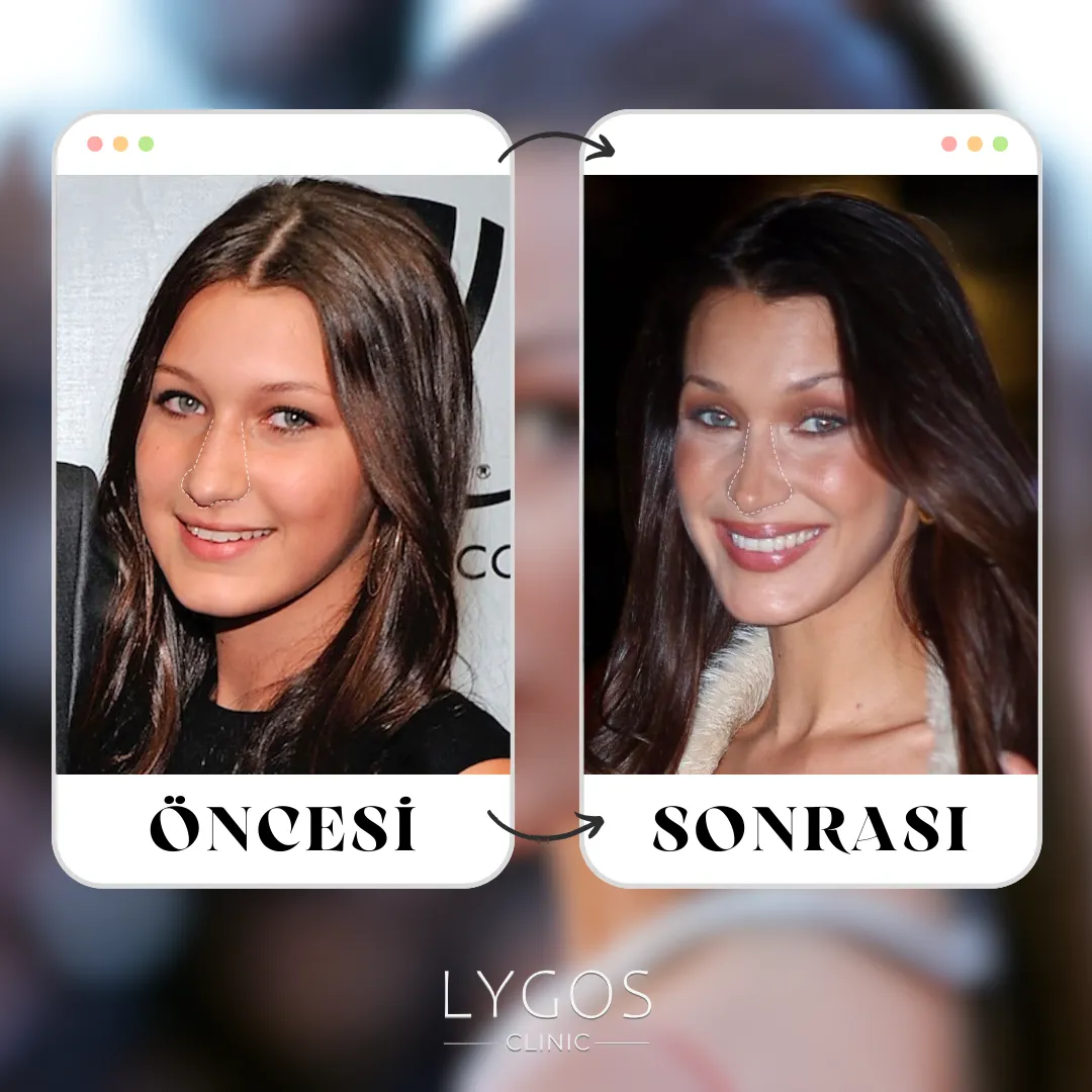 Bella Hadid Burun Estetiği | Ünlülerde Burun Estetiği 1 Bella Hadid Burun Estetiği
