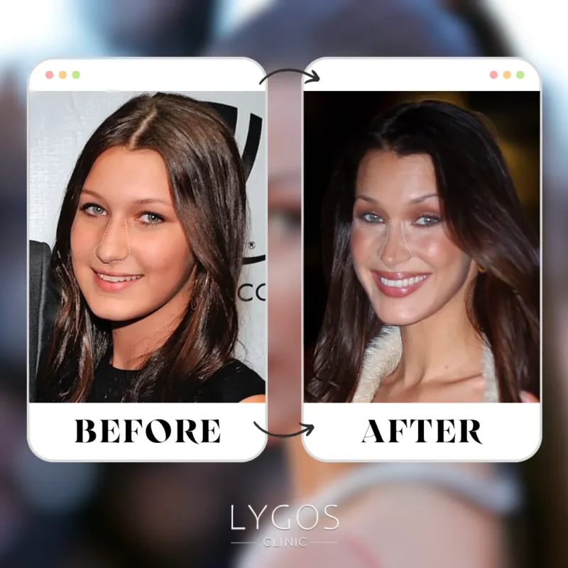 Bella Hadid Rhinoplasty