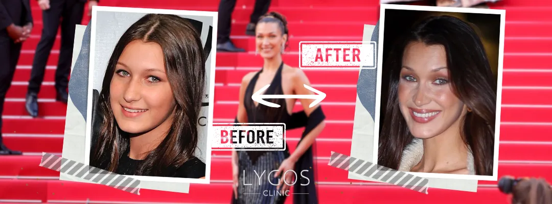 Bella Hadid Rhinoplasty Before and After