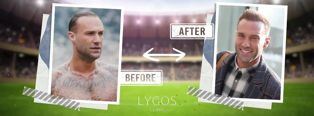 Calum Best Before and After Hair Transplant