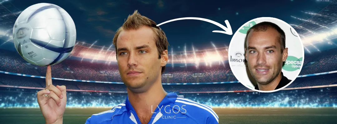 Calum Best Hair Loss