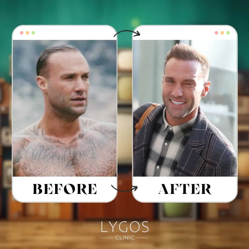 Calum Best Hair Transplant