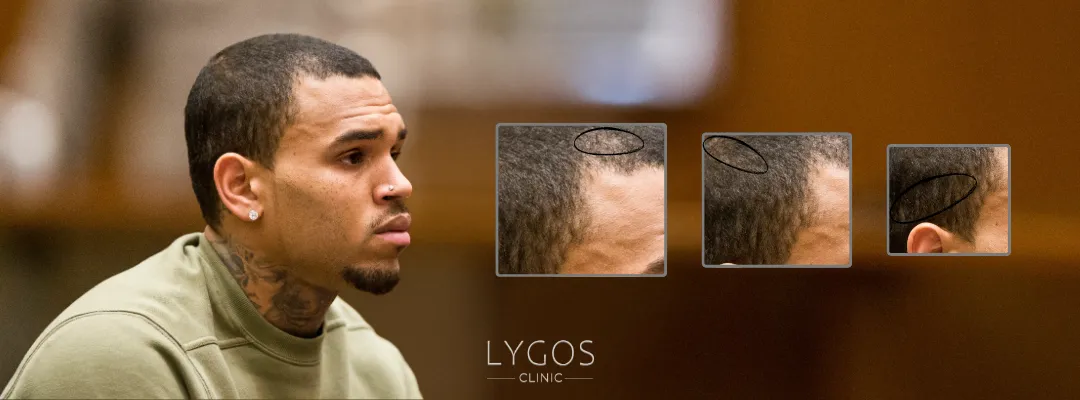 Chris Brown Hair Transplant