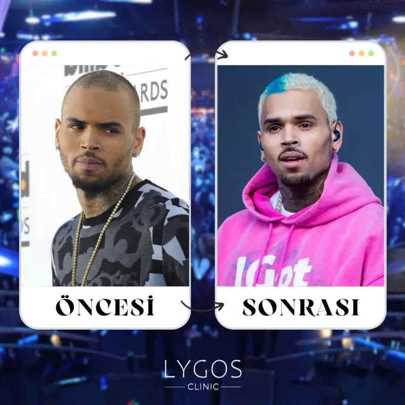 Chris Brown Saç Ekimi