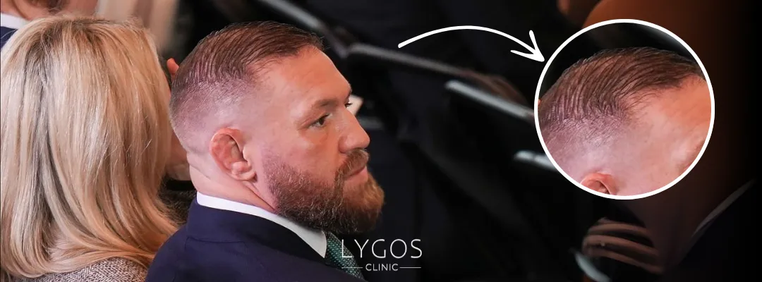 Conor McGregor Saç Dökülmesi