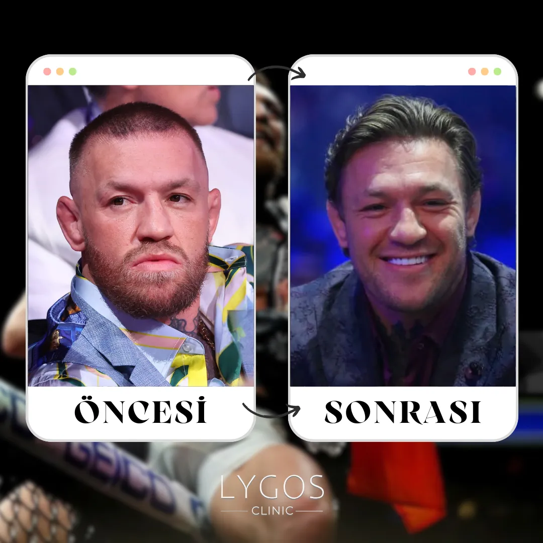 Conor McGregor Saç Ekimi | Ünlülerin Saç Ekimi 1 Conor McGregor Saç Ekimi