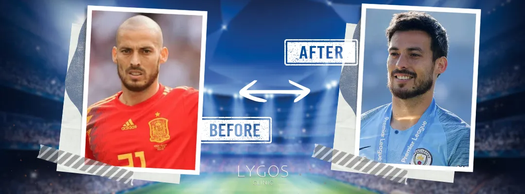 David Silva Before and After Hair Transplant