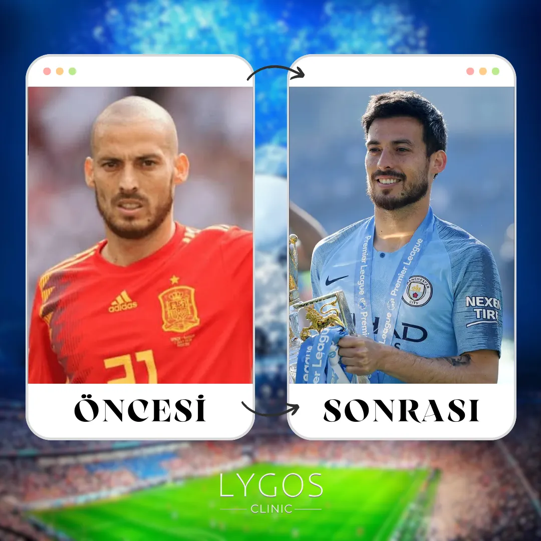 David Silva Saç Ekimi | Öncesi ve Sonrası | LYGOS 2025 1 David Silva Saç Ekimi
