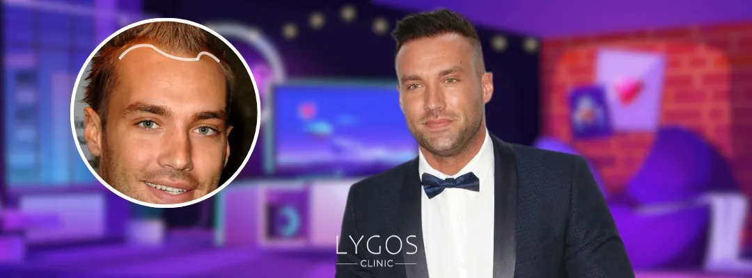 Did Calum Best Get a Hair Transplant?