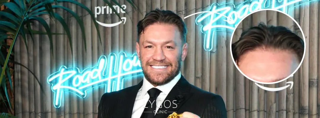 Did Conor McGregor Get a Hair Transplant?