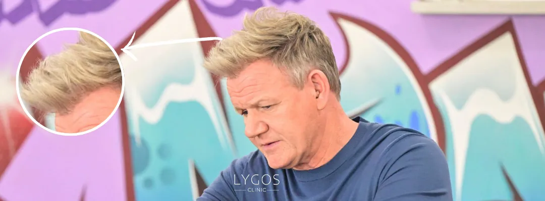 Did Gordon Ramsay Get a Hair Transplant?