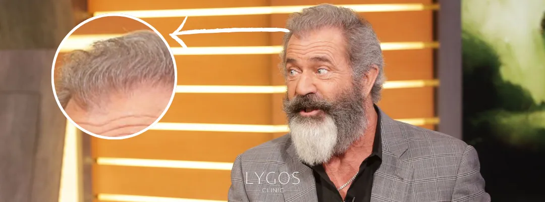 Did Mel Gibson Get a Hair Transplant?