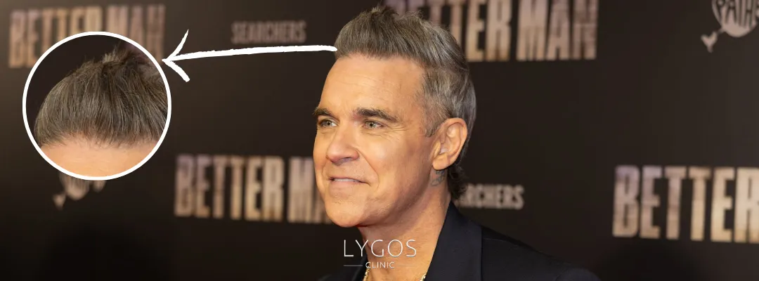 Did Robbie Williams Get a Hair Transplant?