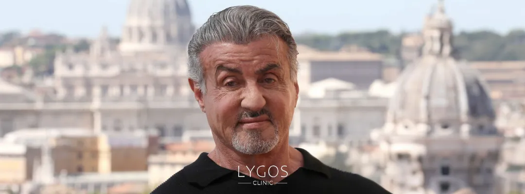 Did Sylvester Stallone Get a Hair Transplant?