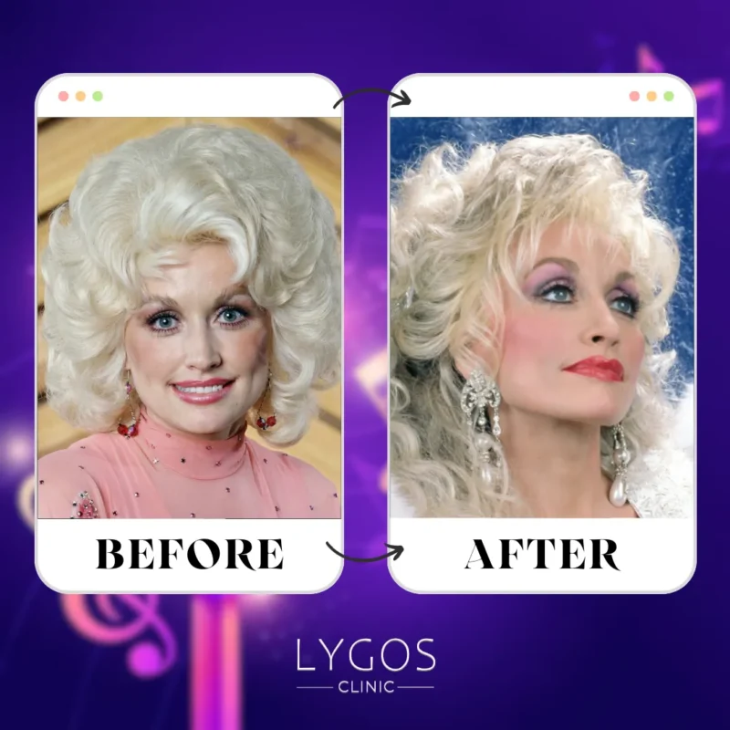 Dolly Parton Rhinoplasty