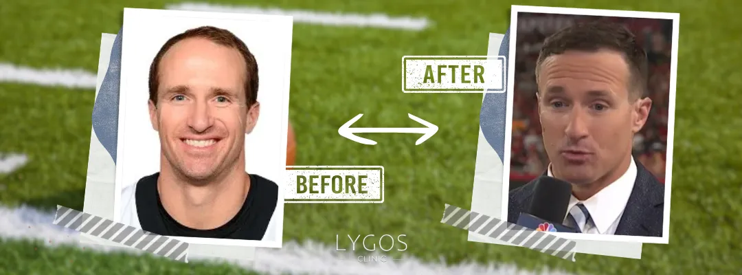 Drew Brees Before and After Hair Transplant