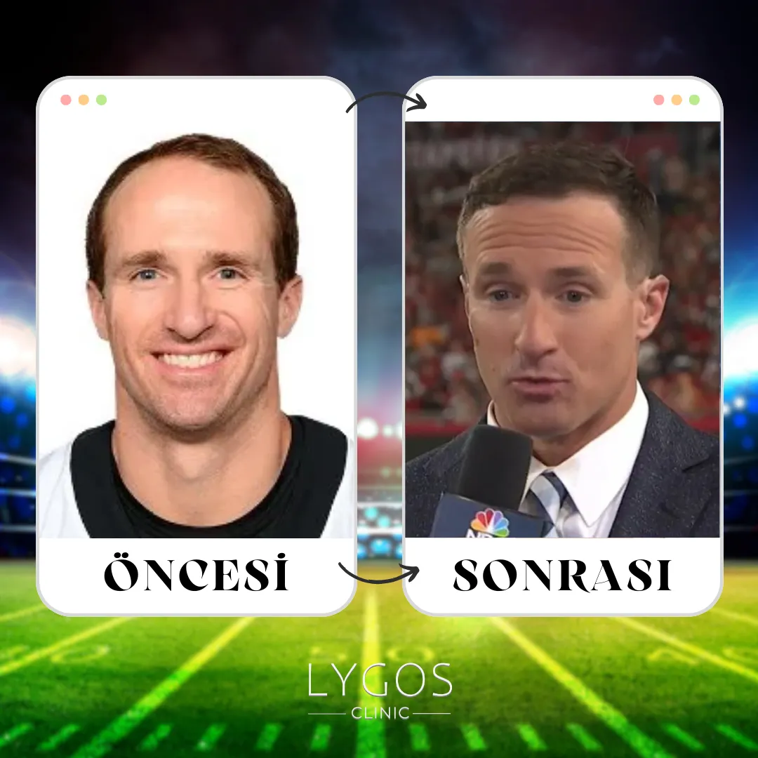 Drew Brees Saç Ekimi | Öncesi ve Sonrası | LYGOS 2025 1 Drew Brees Saç Ekimi