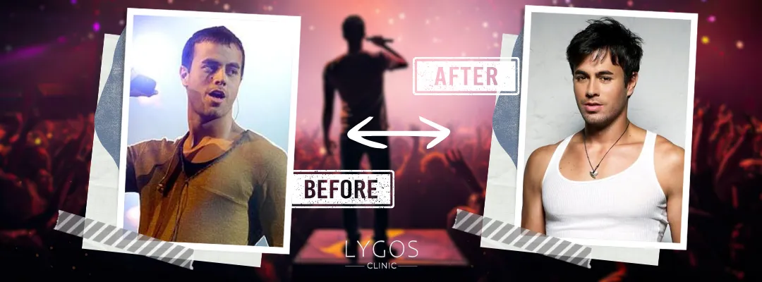 Enrique Iglesias Before and After Hair Transplant