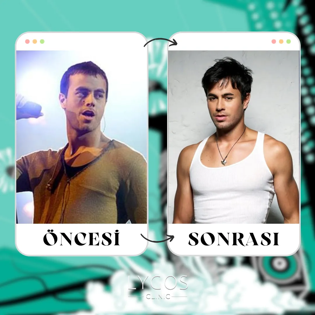 Enrique Iglesias Saç Ekimi | Öncesi ve Sonrası 1 Enrique Iglesias Saç Ekimi