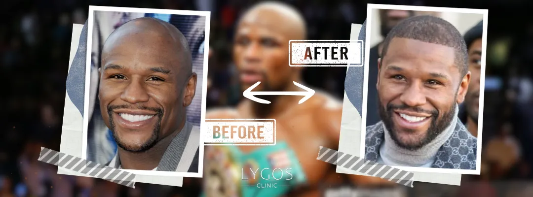 Floyd Mayweather Before and After Hair Transplant