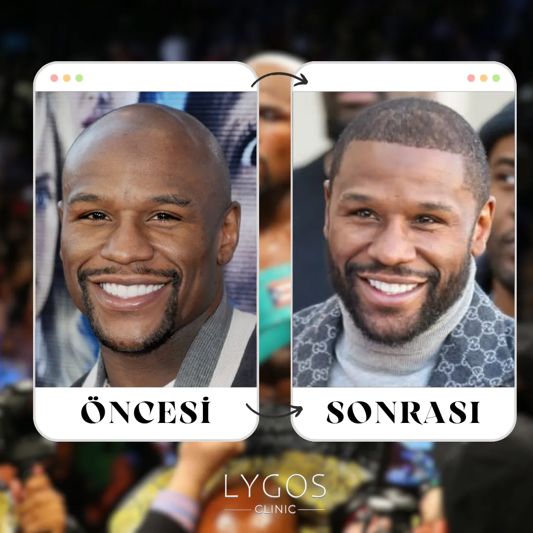 Floyd Mayweather Saç Ekimi | Ünlülerin Saç Ekimi 1 Floyd Mayweather Saç Ekimi