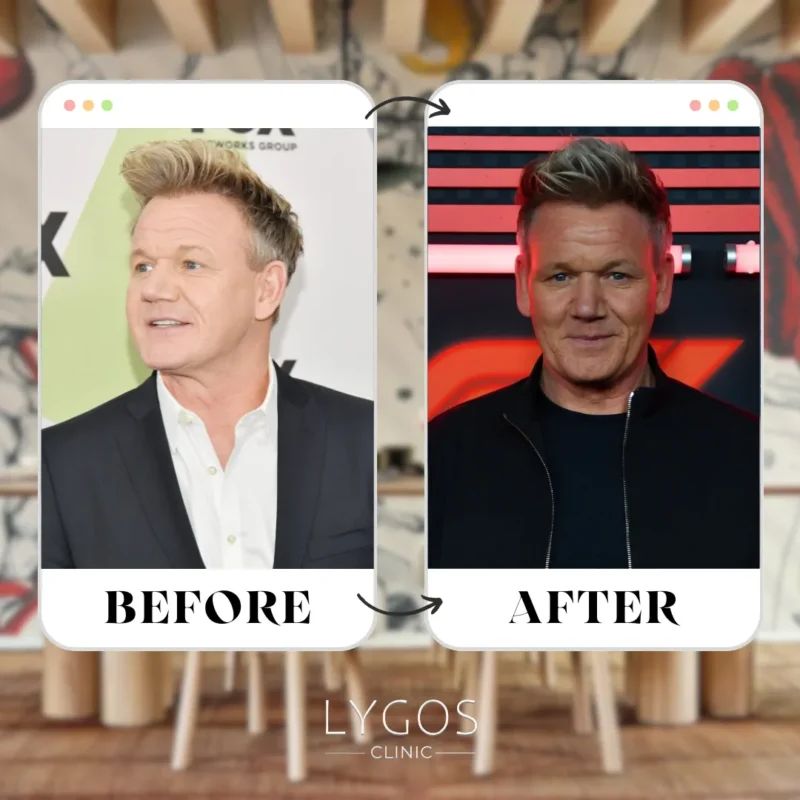 Gordon Ramsay Hair Transplant