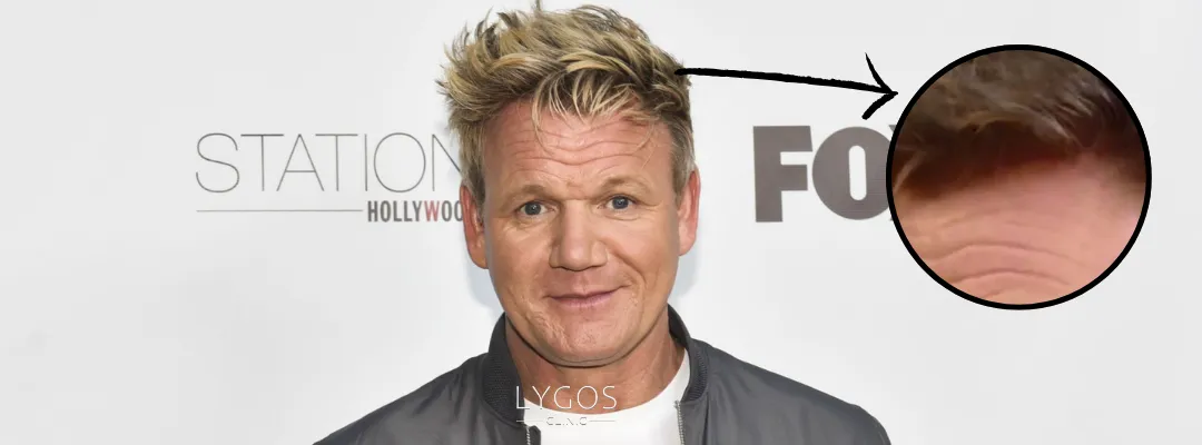 Gordon Ramsay Saç Dökülmesi