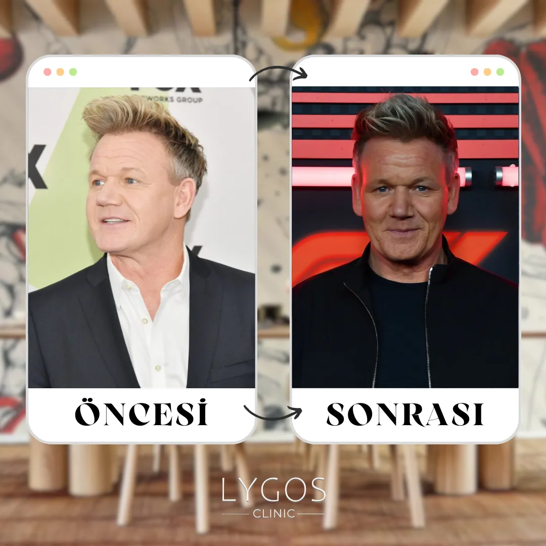 Gordon Ramsay Saç Ekimi | Öncesi ve Sonrası 1 Gordon Ramsay Saç Ekimi