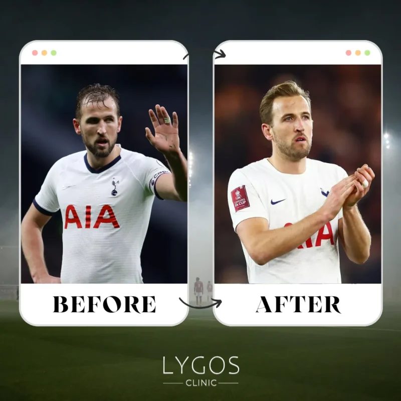 Harry Kane Hair Transplant