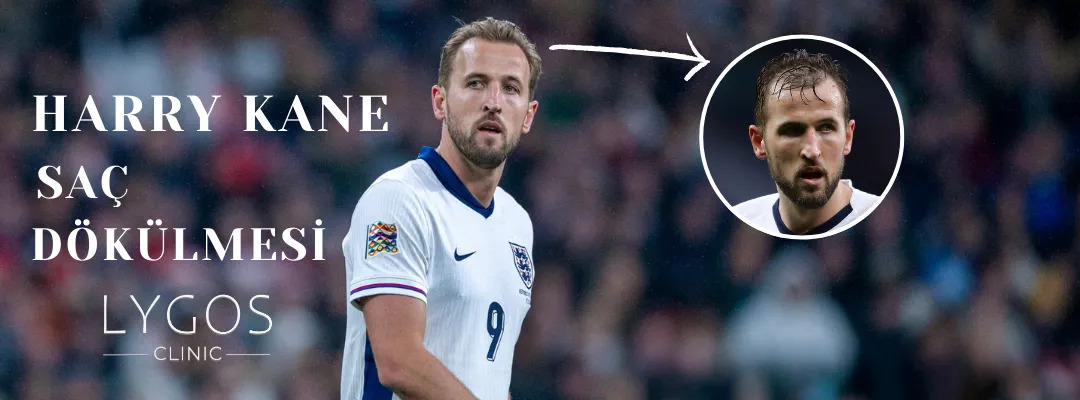 Harry Kane’in Saç Dökülmesi