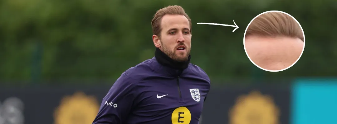 Harry Kane Saç Ekimi Yaptırdı mı?