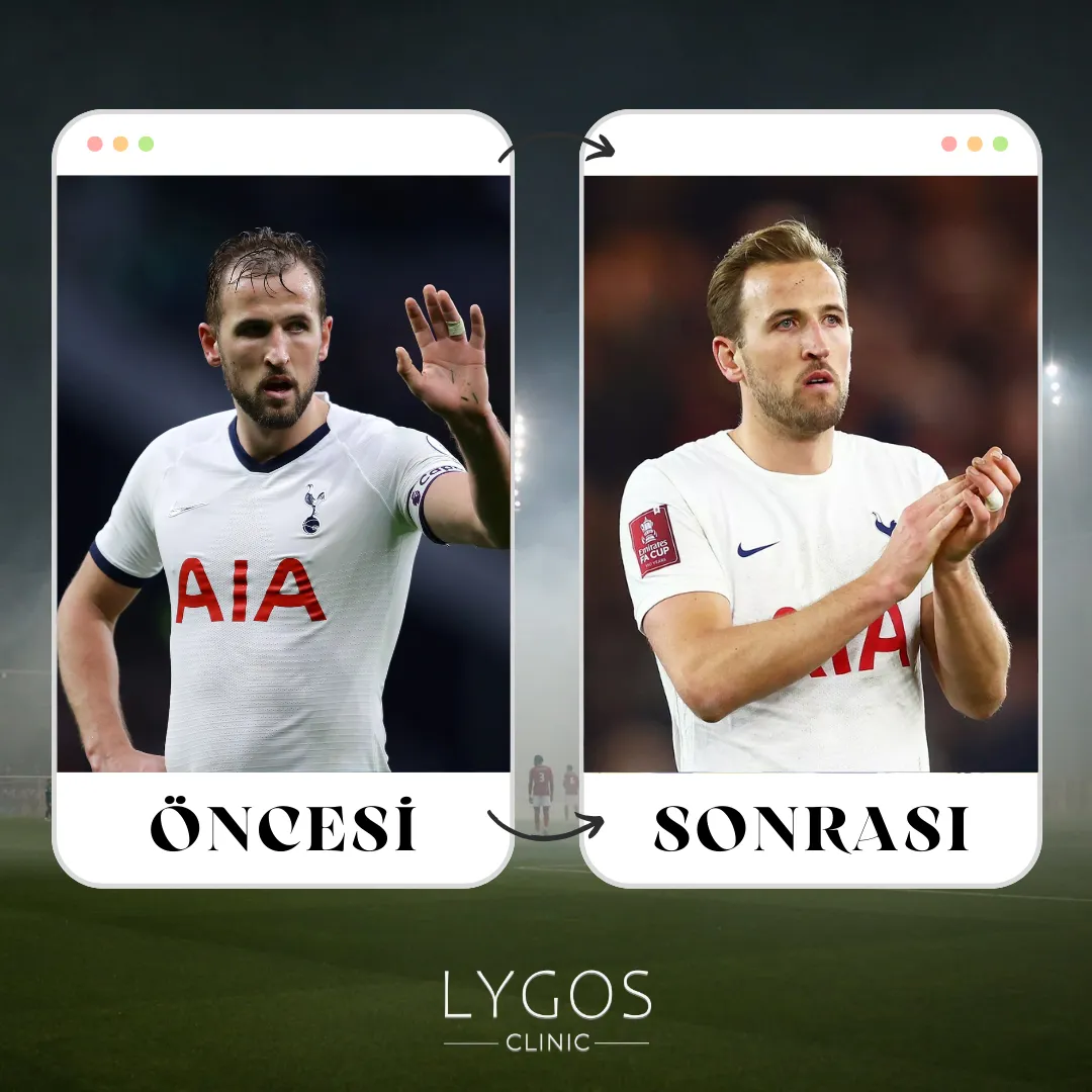 Harry Kane Saç Ekimi | Öncesi ve Sonrası | LYGOS 2025 1 Harry Kane Saç Ekimi