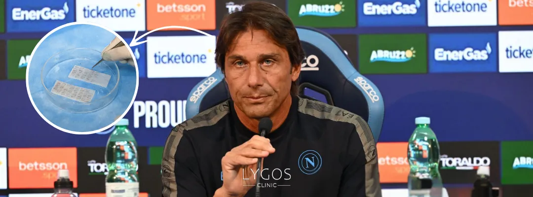 How Many Grafts of Hair Transplant Was Performed on Antonio Conte?