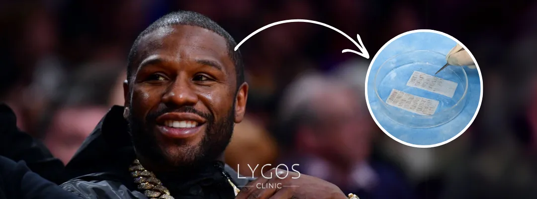 How Many Grafts of Hair Transplant Was Performed on Floyd Mayweather?