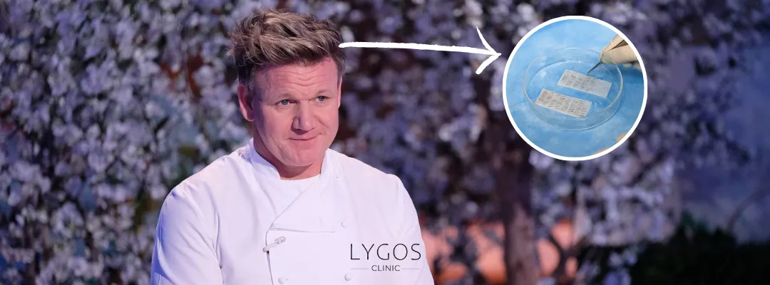 How Many Grafts of Hair Transplant Was Performed on Gordon Ramsay?