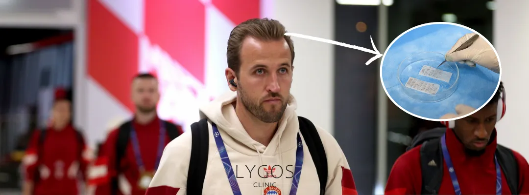 How Many Grafts of Hair Transplant Was Performed on Harry Kane?