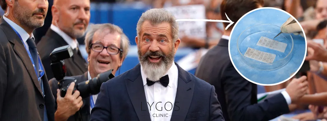 How Many Grafts of Hair Transplant Was Performed on Mel Gibson?