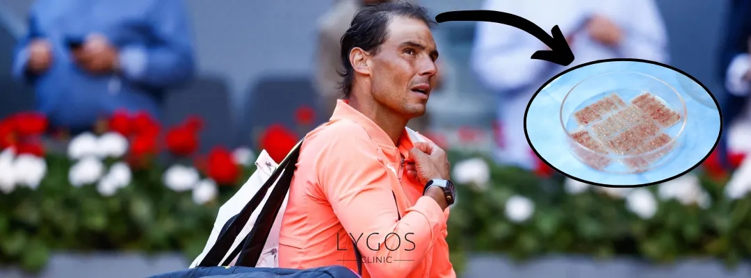 How Many Grafts of Hair Transplant Was Performed on Rafael Nadal?