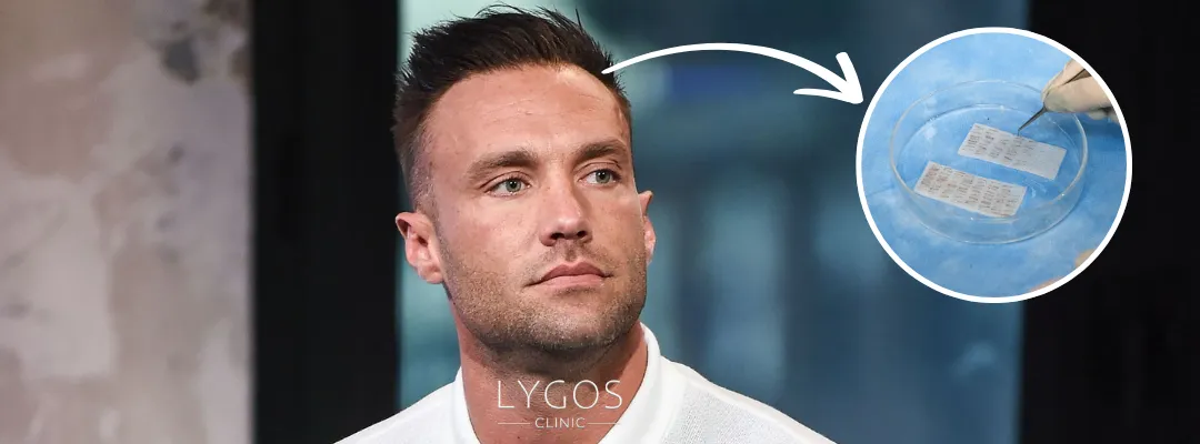 How Many Grafts of Hair Transplant Were Performed on Calum Best?