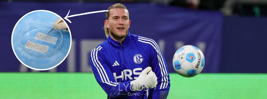 How Many Grafts of Hair Transplant Were Performed on Loris Karius?