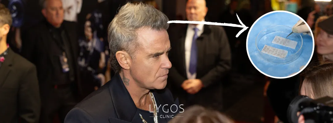 How Many Grafts of Hair Transplant Were Performed on Robbie Williams?