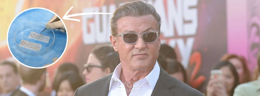 How Many Grafts of Sylvester Stallone Hair Transplant Was Performed?