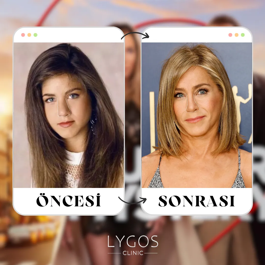 Jennifer Aniston Burun Estetiği | Ünlülerde Burun Estetiği 1 Jennifer Aniston Burun Estetiği