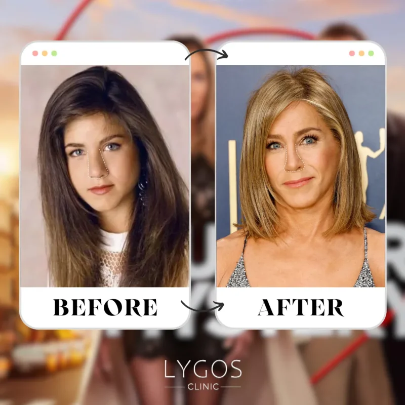 Jennifer Aniston Rhinoplasty