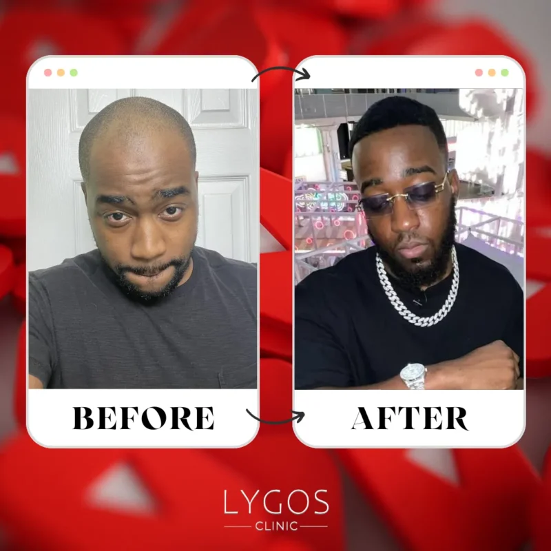 JiDion Hair Transplant